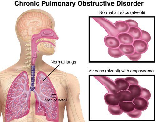 COPD-Small