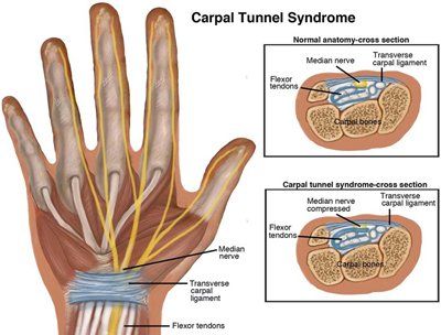 Carpal Tunnel-Small