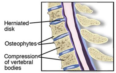 Degenerative Disk Disease - Cervical - Medium