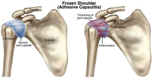 Frozen Shoulder-Small.jpg