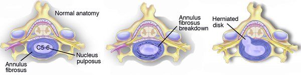 Herniated Disk - Large