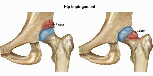 Hip Impingement-Small