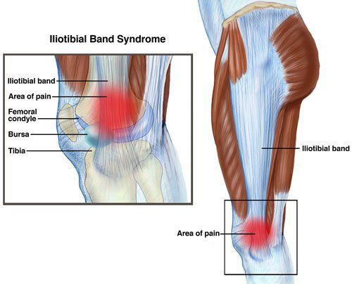 Iliotibial Band-Small