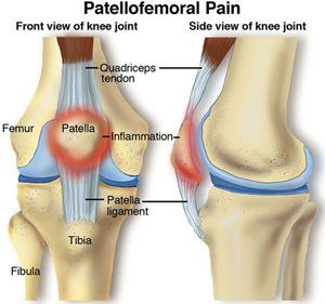 Patellofemoral Pain-Small