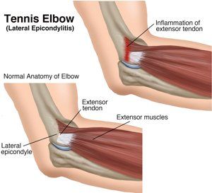 Tennis Elbow-Small