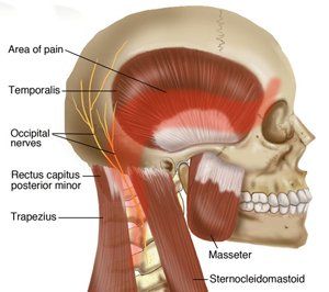 Tension Headache