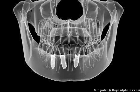 Digitaler Volumen-Tomograph für genaue Implantat-Positionierung Digitaler Volumen-Tomograph für genaue Implantat-Positionierung