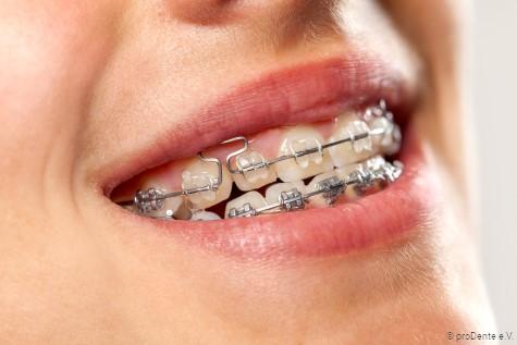 Festsitzende Zahnspangen mit transparenten bzw. Brackets aus Metall Festsitzende Zahnspangen mit transparenten bzw. Brackets aus Metall