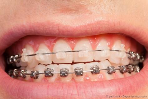 Transparente bzw. Brackets aus Metall, mehr und weniger sichtbar Transparente bzw. Brackets aus Metall, mehr und weniger sichtbar