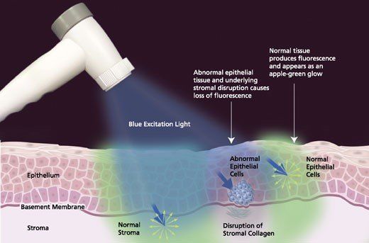 Oral Cancer Screening — Kingston, NY — Joseph Diacovo, DMD Oral Cancer Screening — Kingston, NY — Joseph Diacovo, DMD