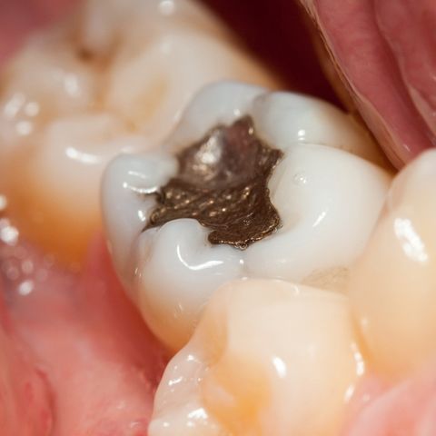 Dental Fillings — Kingston, NY — Joseph Diacovo, DMD Dental Fillings — Kingston, NY — Joseph Diacovo, DMD