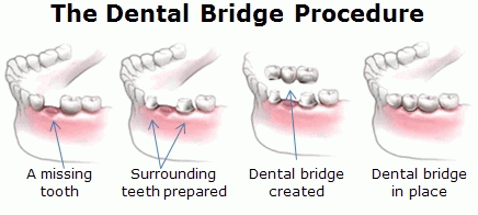 Dental Bridge Procedure — Kingston, NY — Joseph Diacovo, DMD Dental Bridge Procedure — Kingston, NY — Joseph Diacovo, DMD