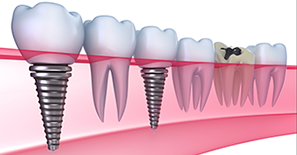 Dental Implants — Kingston, NY — Joseph Diacovo, DMD Dental Implants — Kingston, NY — Joseph Diacovo, DMD