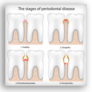 Gum Disease — Kingston, NY — Joseph Diacovo, DMD Gum Disease — Kingston, NY — Joseph Diacovo, DMD