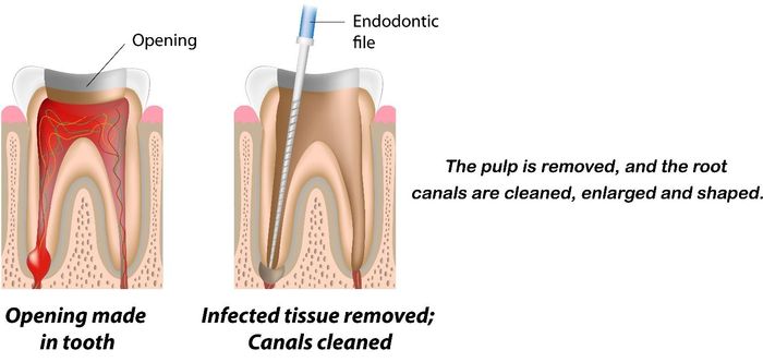 Root Canal Treatment — Kingston, NY — Joseph Diacovo, DMD Root Canal Treatment — Kingston, NY — Joseph Diacovo, DMD