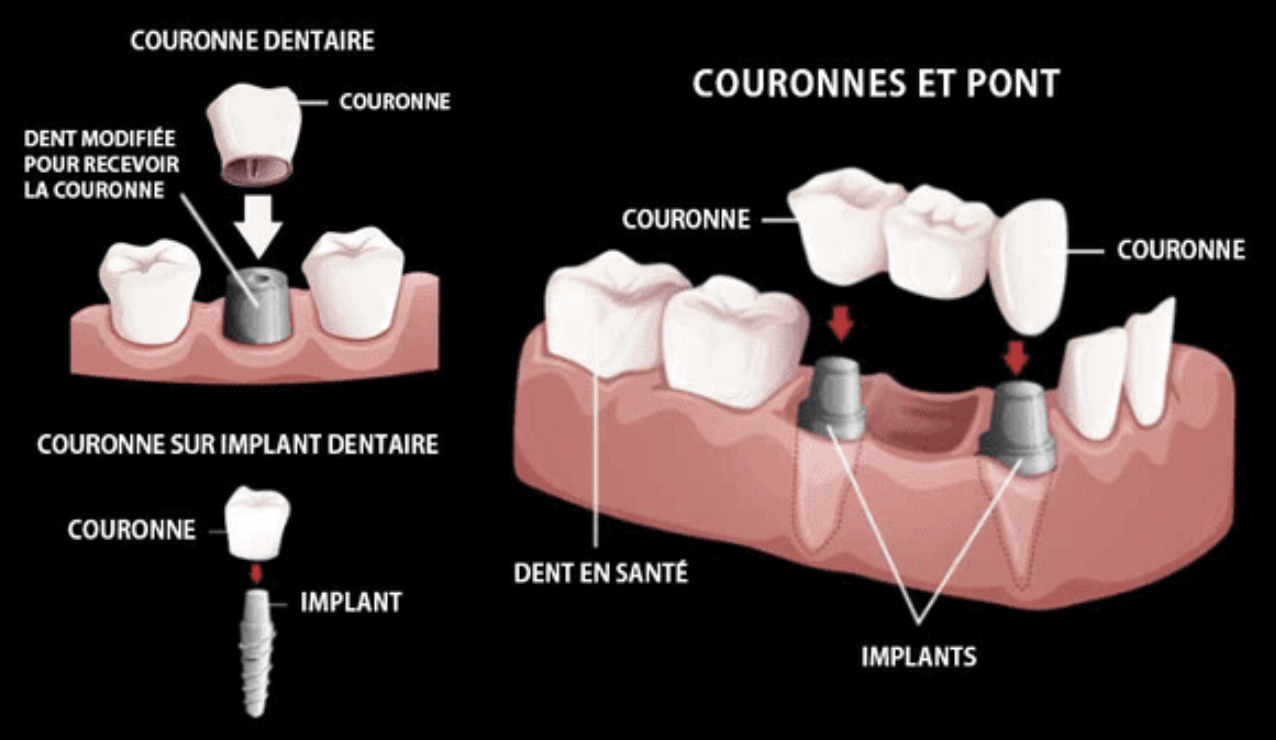 Schéma illustrant les couronnes et les bridges dentaires. Il illustre la pose des couronnes sur des dents modifiées et des implants, et la manière dont un bridge recouvre les dents manquantes grâce à des couronnes.