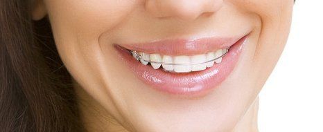 Inman aligners