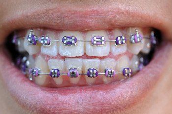 teeth braces