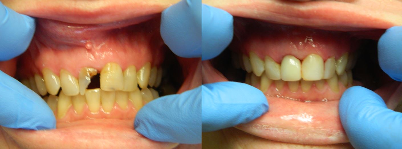 Before and After of Cosmetic Dental Care — Alliance, OH — Kristine Sigworth, DDS