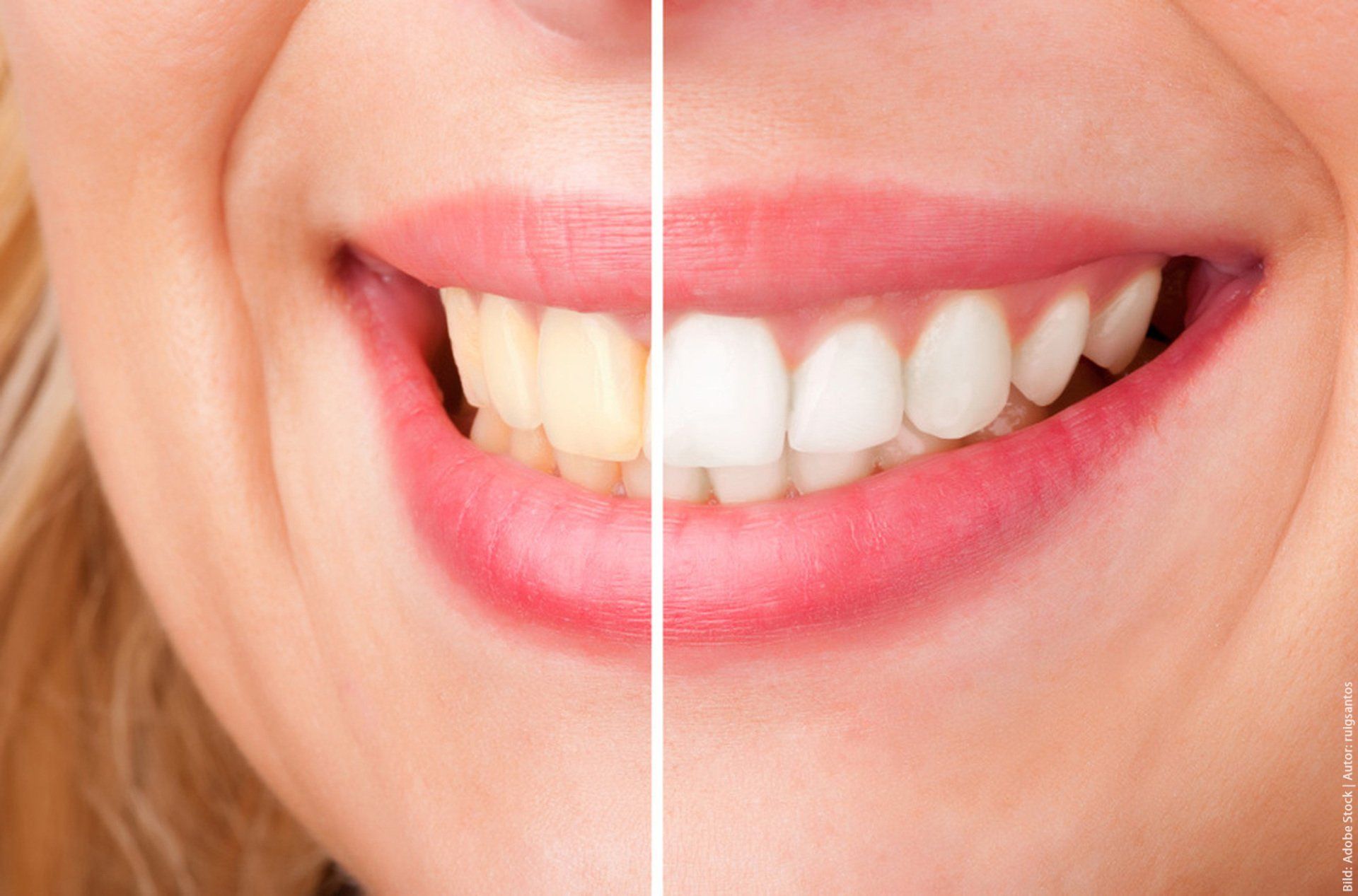 A close-up of a woman’s teeth before and after whitening.