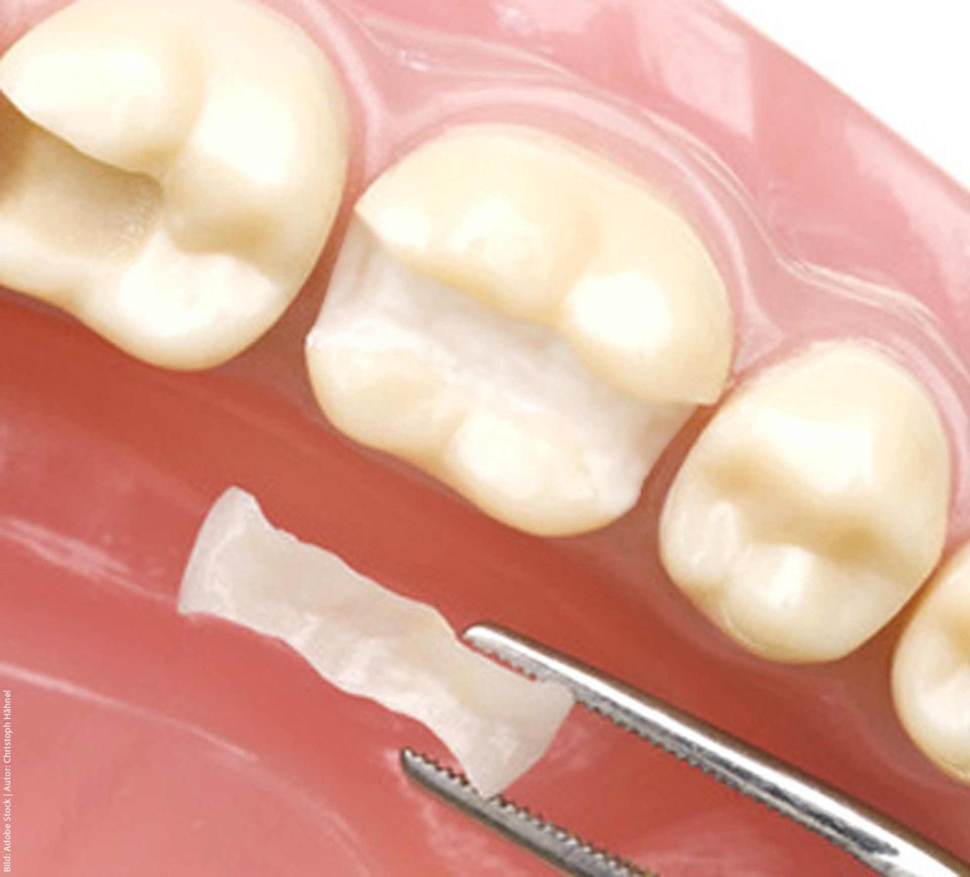 A close-up of a tooth with a dab of toothpaste on it.