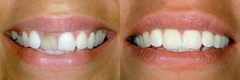 Syosset Dentist | Syosset dental Smile Gallery | Syosset Dentist | Syosset dental Smile Gallery |