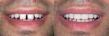 Syosset Dentist | Syosset dental Smile Gallery | Syosset Dentist | Syosset dental Smile Gallery |