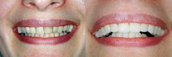 Syosset Dentist | Syosset dental Smile Gallery | Syosset Dentist | Syosset dental Smile Gallery |