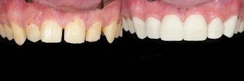 Syosset Dentist | Syosset dental Smile Gallery | Syosset Dentist | Syosset dental Smile Gallery |
