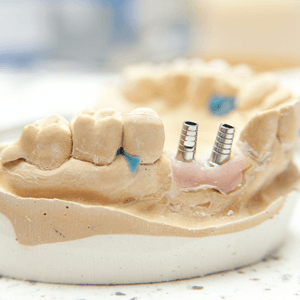 Chrome Cobalt Dentures