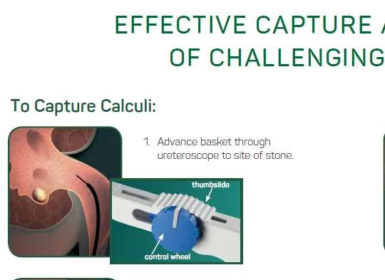 A poster that says effective capture of challenging to capture calculi