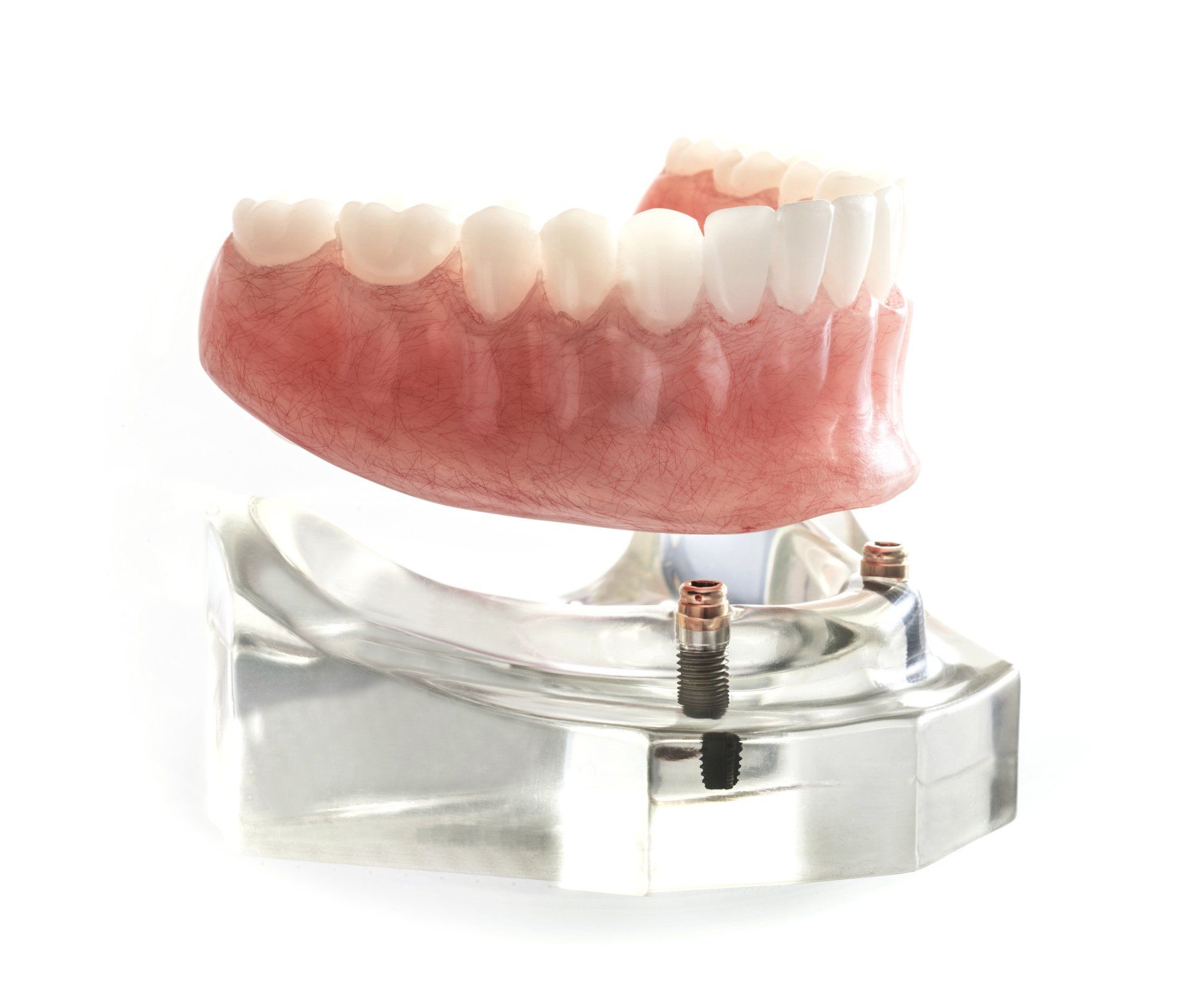 Implant supported dentures Implant supported dentures
