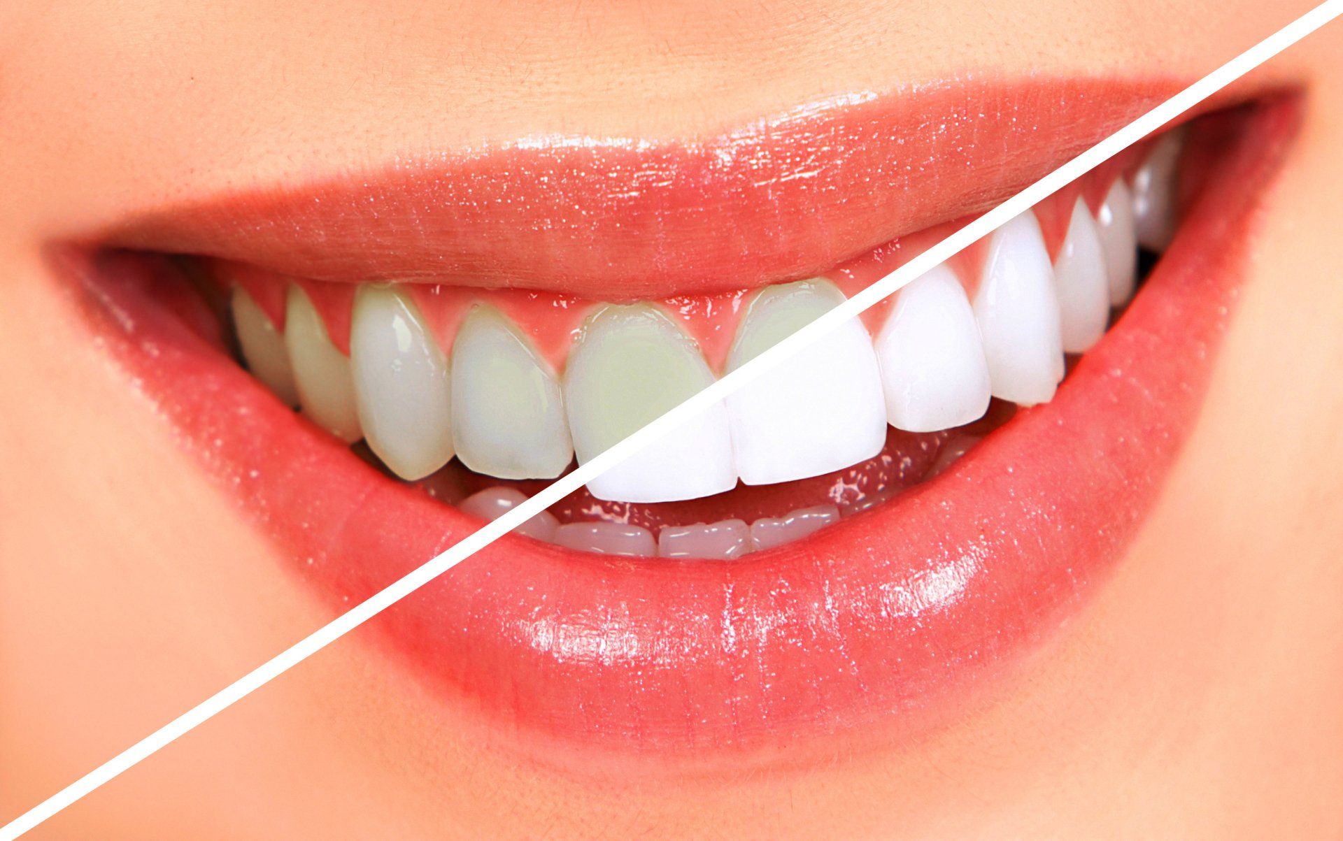 Teeth whitening Teeth whitening