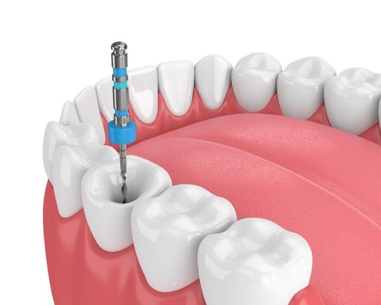 endodonzia