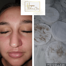 Dermaplanning