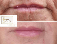 Lips & Marionette Lines