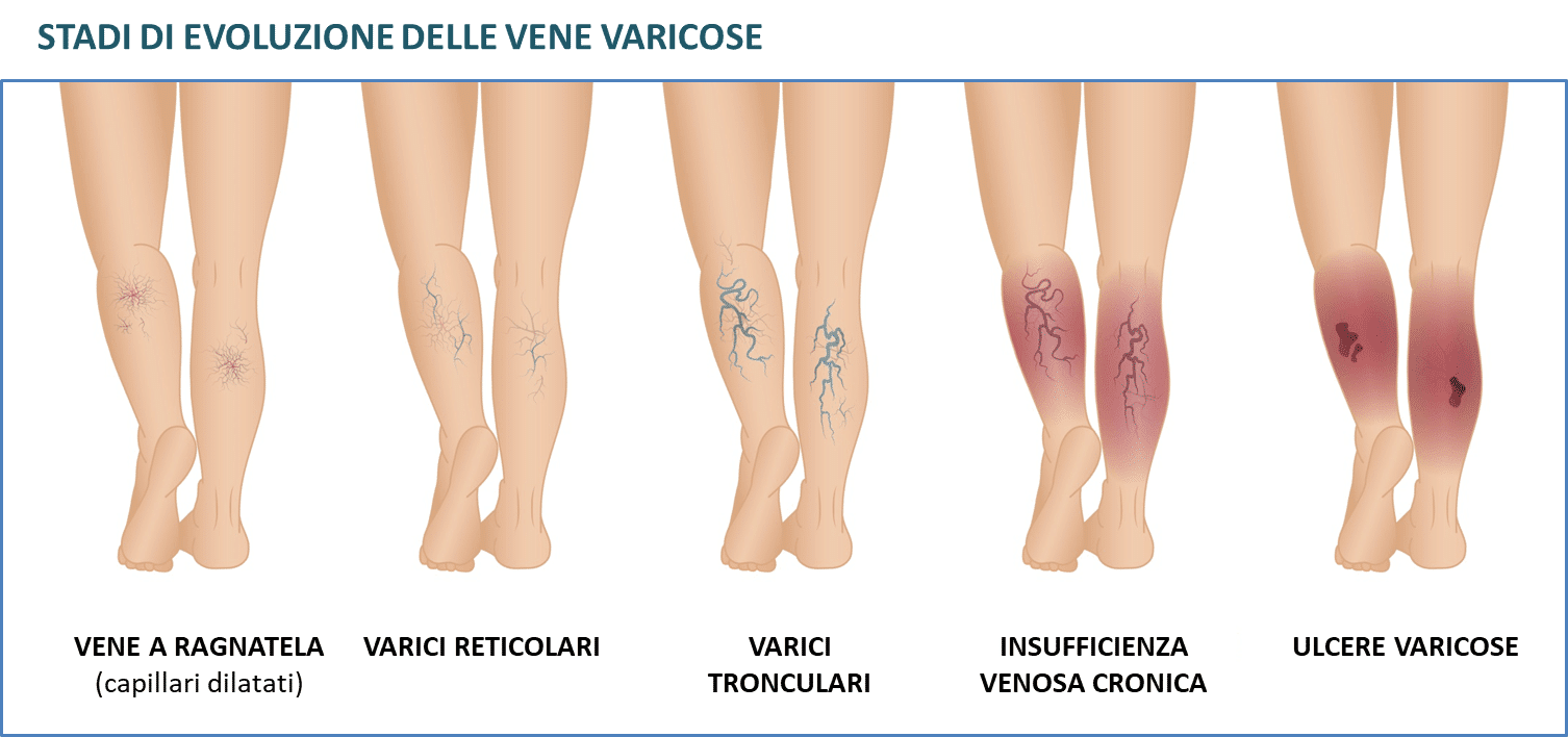 Un'immagine delle gambe di una donna che mostra diversi stadi di vene varicose