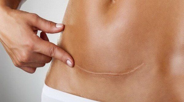 Addome di donna con cicatrice da parto cesareo, mano che la indica.