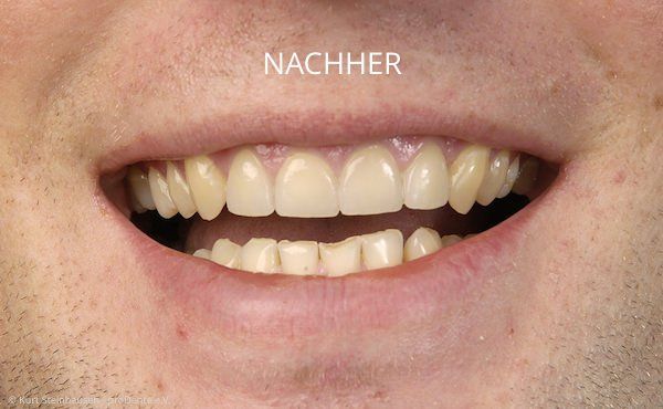 Schneidezähne nach der Behandlung mit Veneers Schneidezähne nach der Behandlung mit Veneers