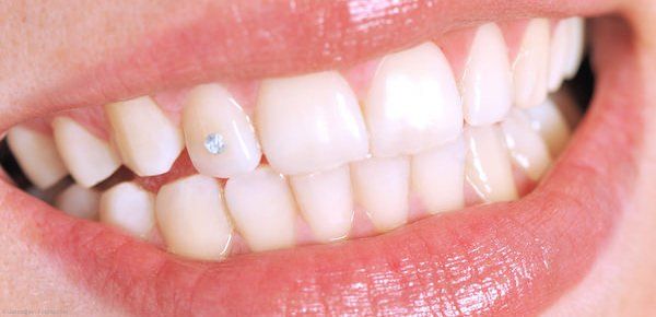 Zahnschmuck: Twinkle Zahnschmuck: Twinkle