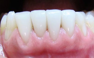 Veneers der unteren vier Schneidezähne bei einer Raucherin vier Jahre nach dem Einsetzen: Es sind keinerlei Verfärbungen sichtbar. Veneers der unteren vier Schneidezähne bei einer Raucherin vier Jahre nach dem Einsetzen: Es sind keinerlei Verfärbungen sichtbar.