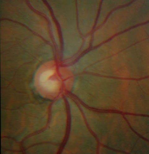 Glaucoma