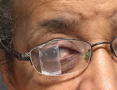 Diplopia After Stroke