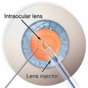 Cataract Post-Operative Billing Can Be Easy!