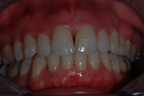Primo piano dei denti e delle gengive di una persona, con un apparecchio ortodontico di contenzione trasparente ben visibile sui denti superiori.