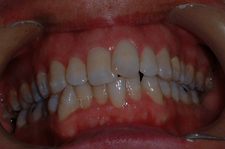 Primo piano di denti con apparecchio metallico e gengive rosse all'interno di una bocca aperta.