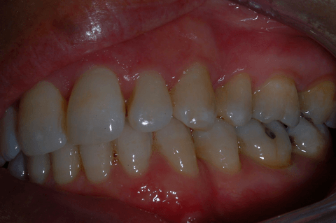 Primo piano di denti e gengive con affollamento e lieve scolorimento