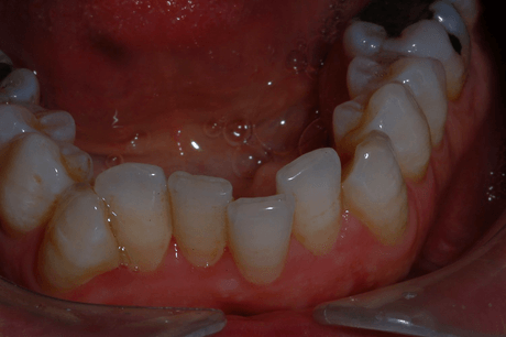 Primo piano dei denti frontali inferiori e delle gengive con affollamento visibile e colorazione giallastra.