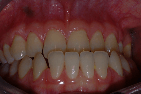 Primo piano di una bocca aperta che mostra i denti, con gli incisivi superiori e inferiori allineati e le gengive visibili.