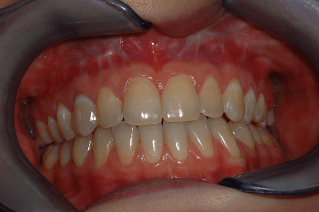 Primo piano dei denti in una bocca retratta da divaricatori dentali per le guance.